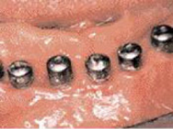 implantna implantna
