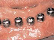 implantna implantna