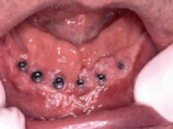 implantvoor implantvoor